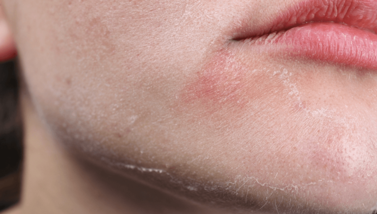 Comment traiter les problèmes de peau sèche en hiver ?