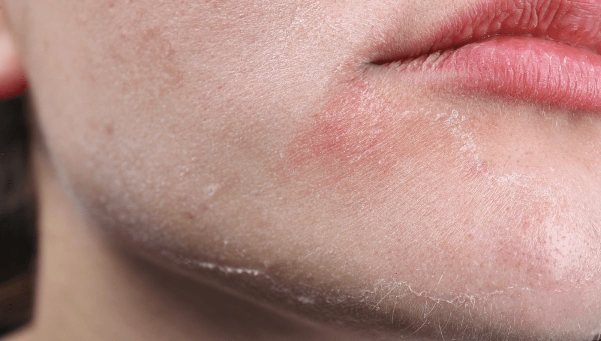 Comment traiter les problèmes de peau sèche en hiver ?