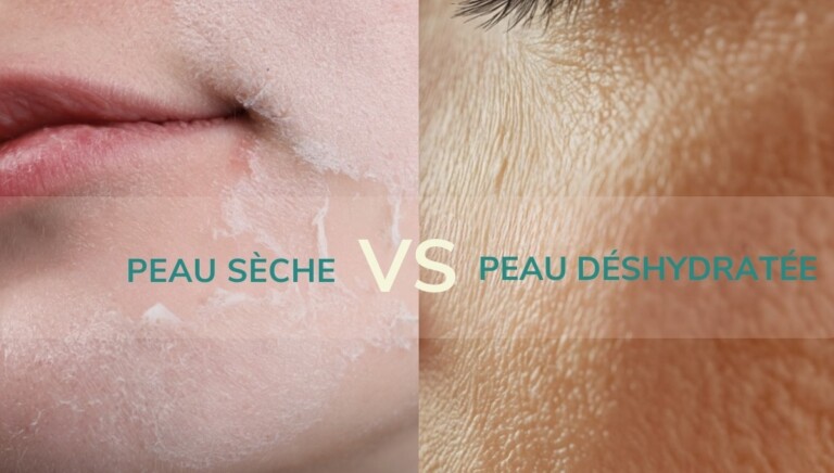 Comment reconnaître une peau déshydratée d&rsquo;une peau sèche ?